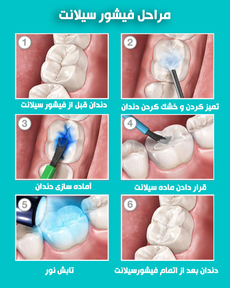 فیشورسیلانت